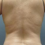 Liposuction Female Before & After Patient #1094