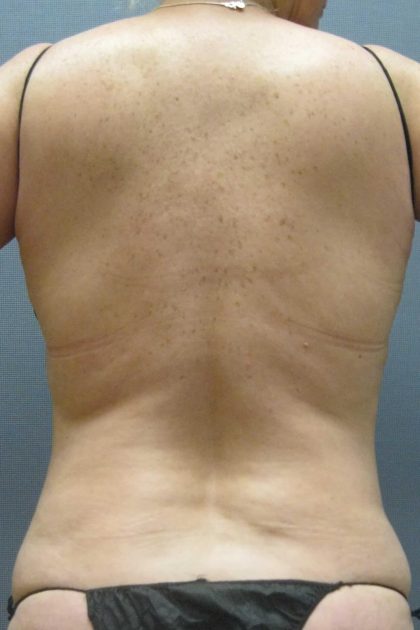 Liposuction Female Before & After Patient #1094