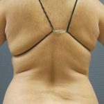 Liposuction Female Before & After Patient #1094