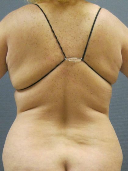 Liposuction Female Before & After Patient #1094