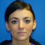 Revision Rhinoplasty Before & After Patient #321