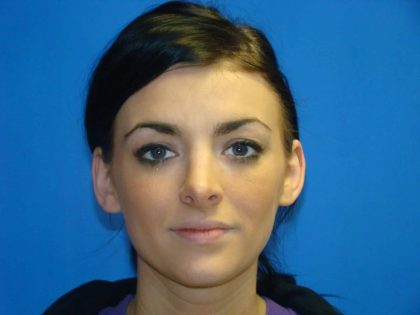Revision Rhinoplasty Before & After Patient #321