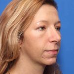 Rhinoplasty Before & After Patient #581