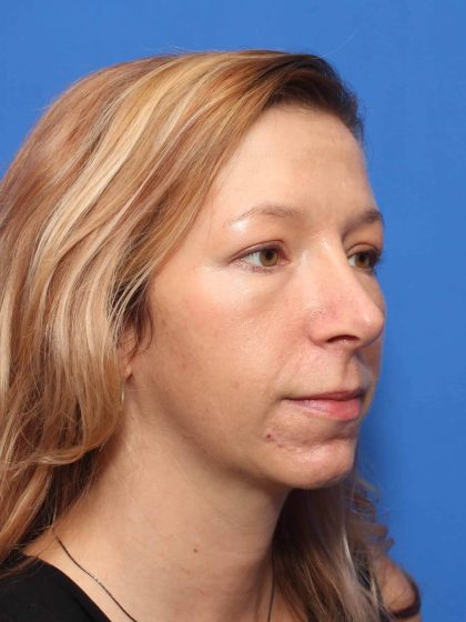 Rhinoplasty Before & After Patient #581