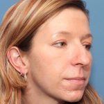 Rhinoplasty Before & After Patient #581