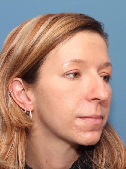 Rhinoplasty Before & After Patient #581