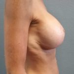 Breast Lift with Implant (Augmentation Mastopexy) Before & After Patient #1052