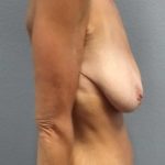 Breast Lift with Implant (Augmentation Mastopexy) Before & After Patient #1052
