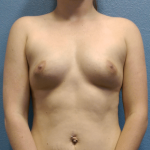 Breast Augmentation Before & After Patient #1499