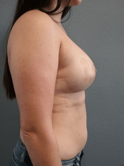 Breast Augmentation Before & After Patient #1499