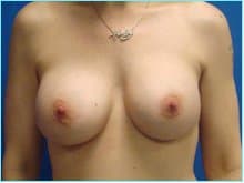 Breast Augmentation Before & After Patient #1561