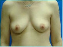 Breast Augmentation Before & After Patient #1561