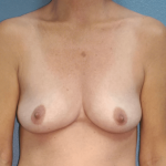 Breast Augmentation Before & After Patient #1474