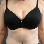 Abdominoplasty Before & After Patient #2060