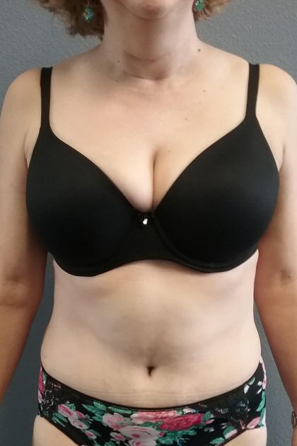 Abdominoplasty Before & After Patient #2060