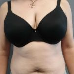 Abdominoplasty Before & After Patient #2060