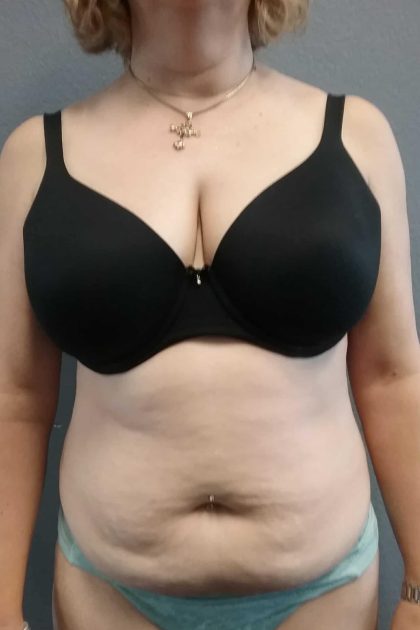 Abdominoplasty Before & After Patient #2060