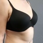 Abdominoplasty Before & After Patient #2060