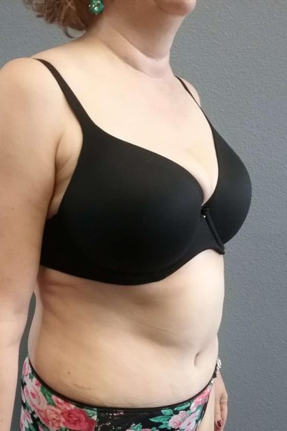 Abdominoplasty Before & After Patient #2060