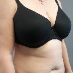 Abdominoplasty Before & After Patient #2060