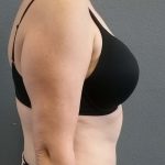Abdominoplasty Before & After Patient #2060