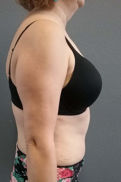 Abdominoplasty Before & After Patient #2060