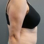 Abdominoplasty Before & After Patient #2060