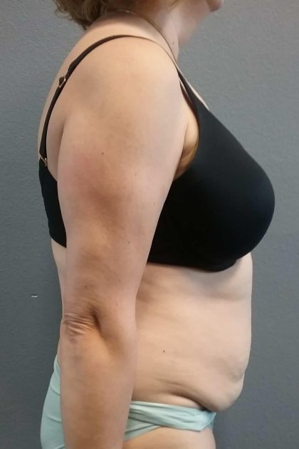 Abdominoplasty Before & After Patient #2060