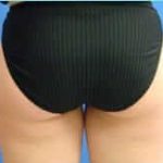 Liposuction Female Before & After Patient #1142