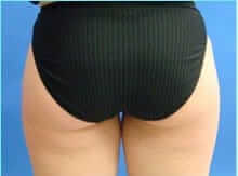Liposuction Female Before & After Patient #1142