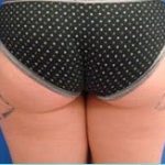 Liposuction Female Before & After Patient #1142