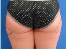 Liposuction Female Before & After Patient #1142