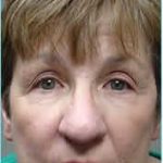 Nose Reconstruction Before & After Patient #619