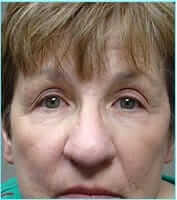 Nose Reconstruction Before & After Patient #619