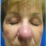 Nose Reconstruction Before & After Patient #619