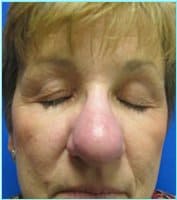 Nose Reconstruction Before & After Patient #619