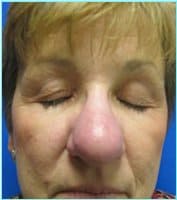 Revision Rhinoplasty Before & After Patient #286