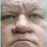 Nose Reconstruction Before & After Patient #626