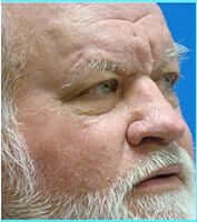 Nose Reconstruction Before & After Patient #626