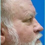 Nose Reconstruction Before & After Patient #626