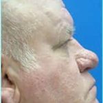 Nose Reconstruction Before & After Patient #626