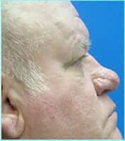 Nose Reconstruction Before & After Patient #626