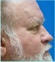 Revision Rhinoplasty Before & After Patient #293
