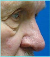 Nose Reconstruction Before & After Patient #633