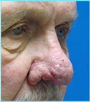 Nose Reconstruction Before & After Patient #633