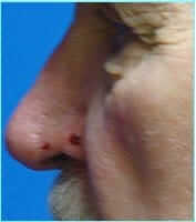 Nose Reconstruction Before & After Patient #633