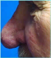 Nose Reconstruction Before & After Patient #633