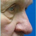 Revision Rhinoplasty Before & After Patient #300