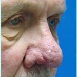 Revision Rhinoplasty Before & After Patient #300