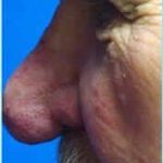 Revision Rhinoplasty Before & After Patient #300